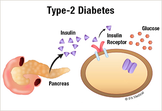 Type-2 Diabetes 